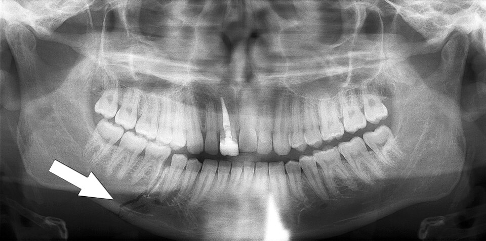 File:Simple mandible fracture.jpg