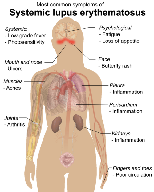 File:Symptoms of SLE.png
