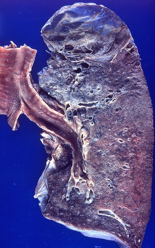 File:Bullous emphysema (4857852447).jpg