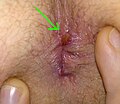 Fissurectomy wound 1.5 weeks after the OP