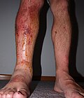 Poison ivy rash with swelling about 3 days after direct contact