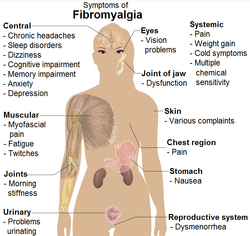 Symptoms of fibromyalgia