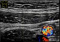 Axial plane, with Doppler signal from the iliac vessels.