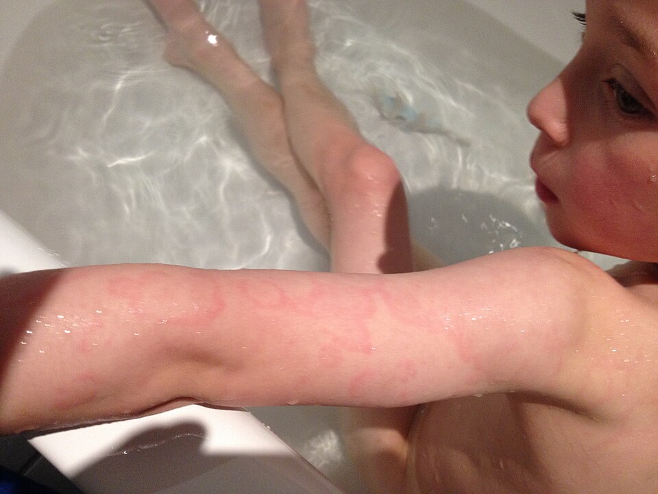 File:Erythema marginatum.jpg