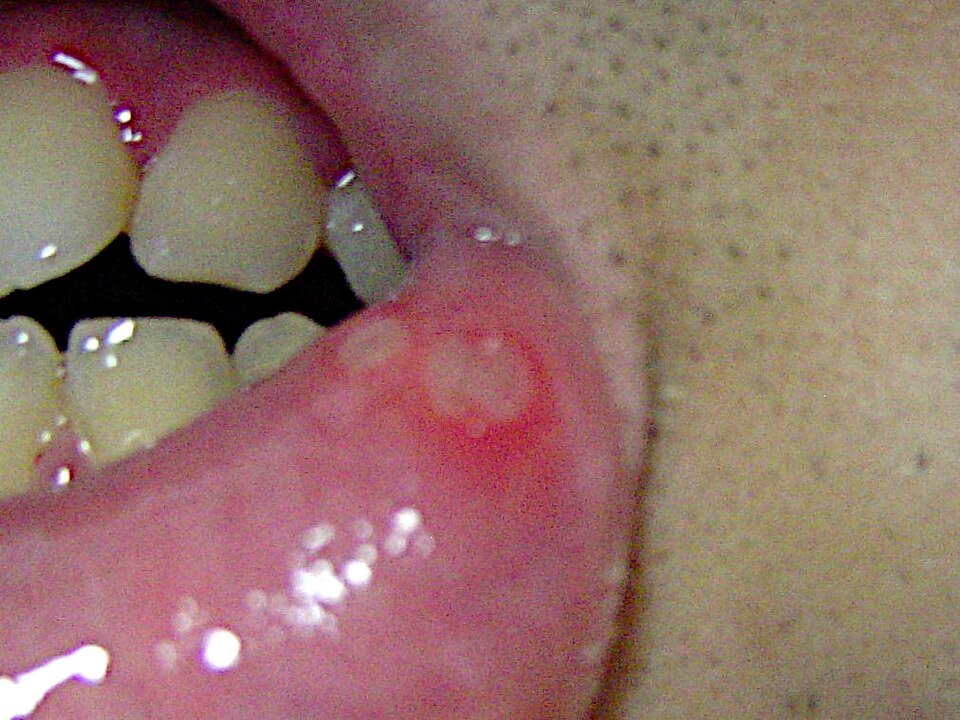 File:Aphthous ulcer.jpg