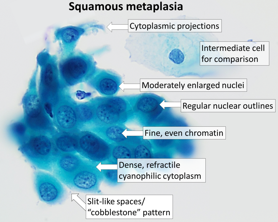 File:Cytology of cervical squamous metaplasia.png