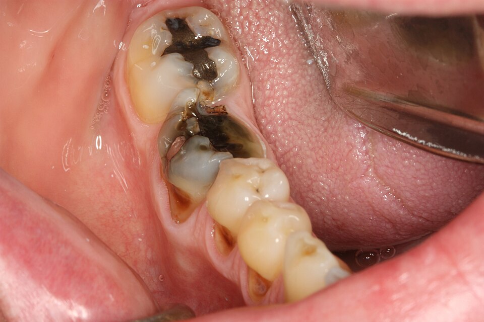 File:Socket preservation broken tooth.jpg