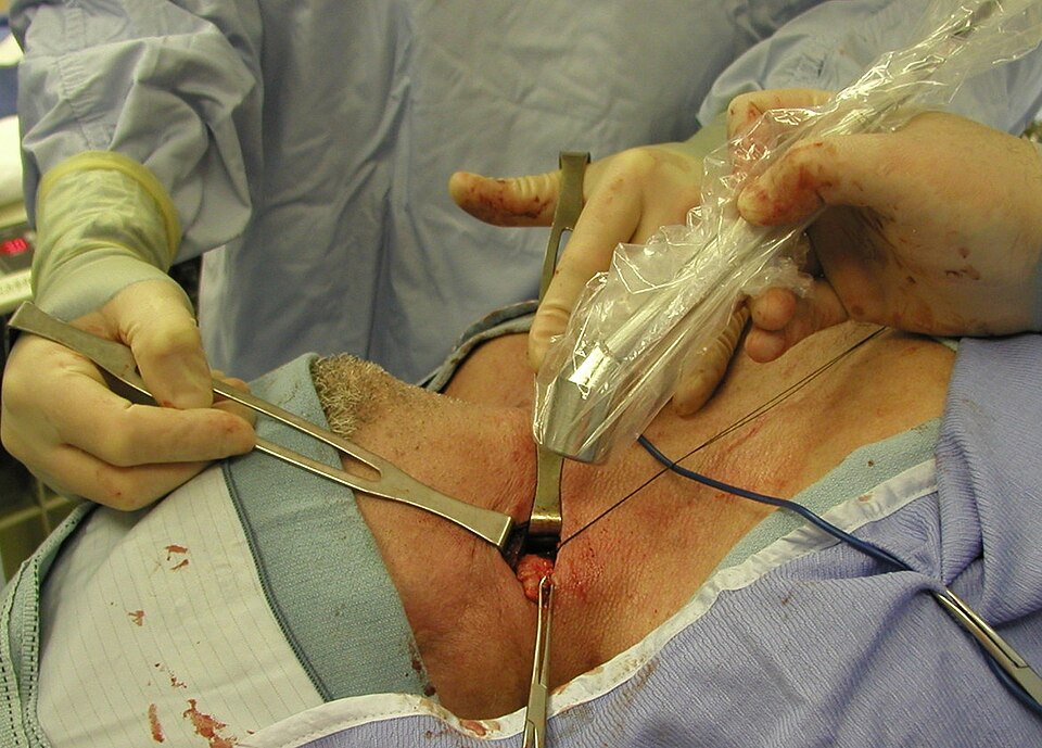 File:Lymph node NPC.jpg