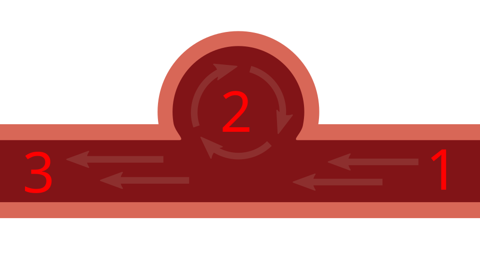 File:Aneurysm vortex.svg