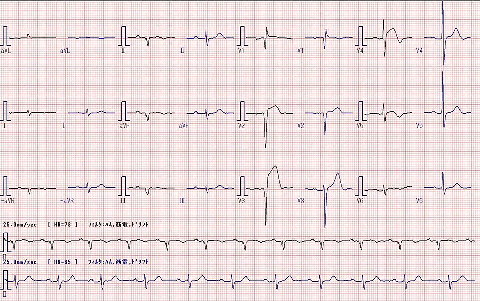 File:ECG V2-4 ST change.jpg