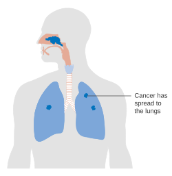 Diagram showing nasal cavity cancer that has spread to the lungs