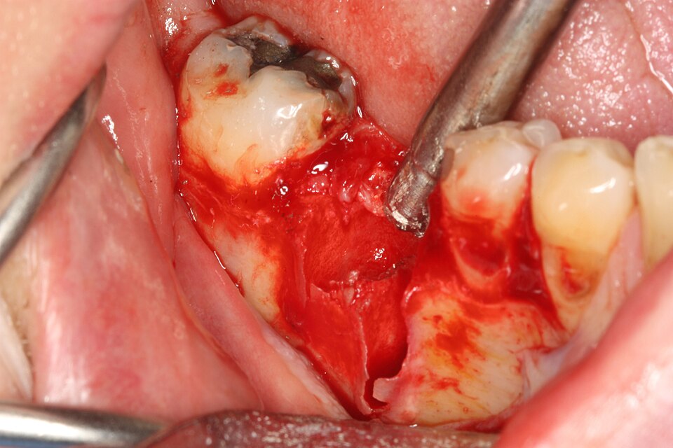 File:Socket preservation extraction socket.jpg