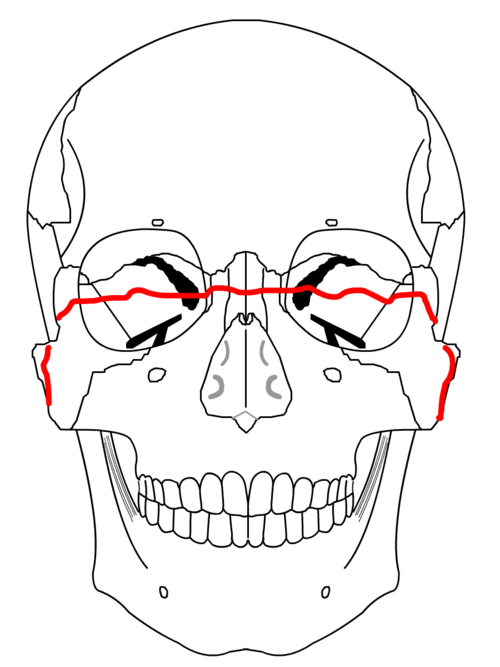 File:LeFort3b.png