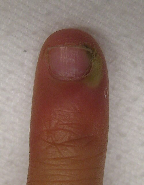 File:Infectionofcutical.JPG