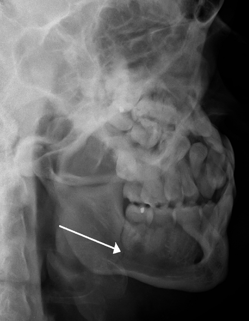 File:Fracturef mandible.PNG