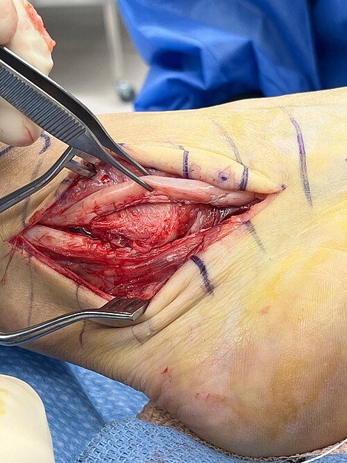 File:Intraoperative fibularis longus tendon.jpg