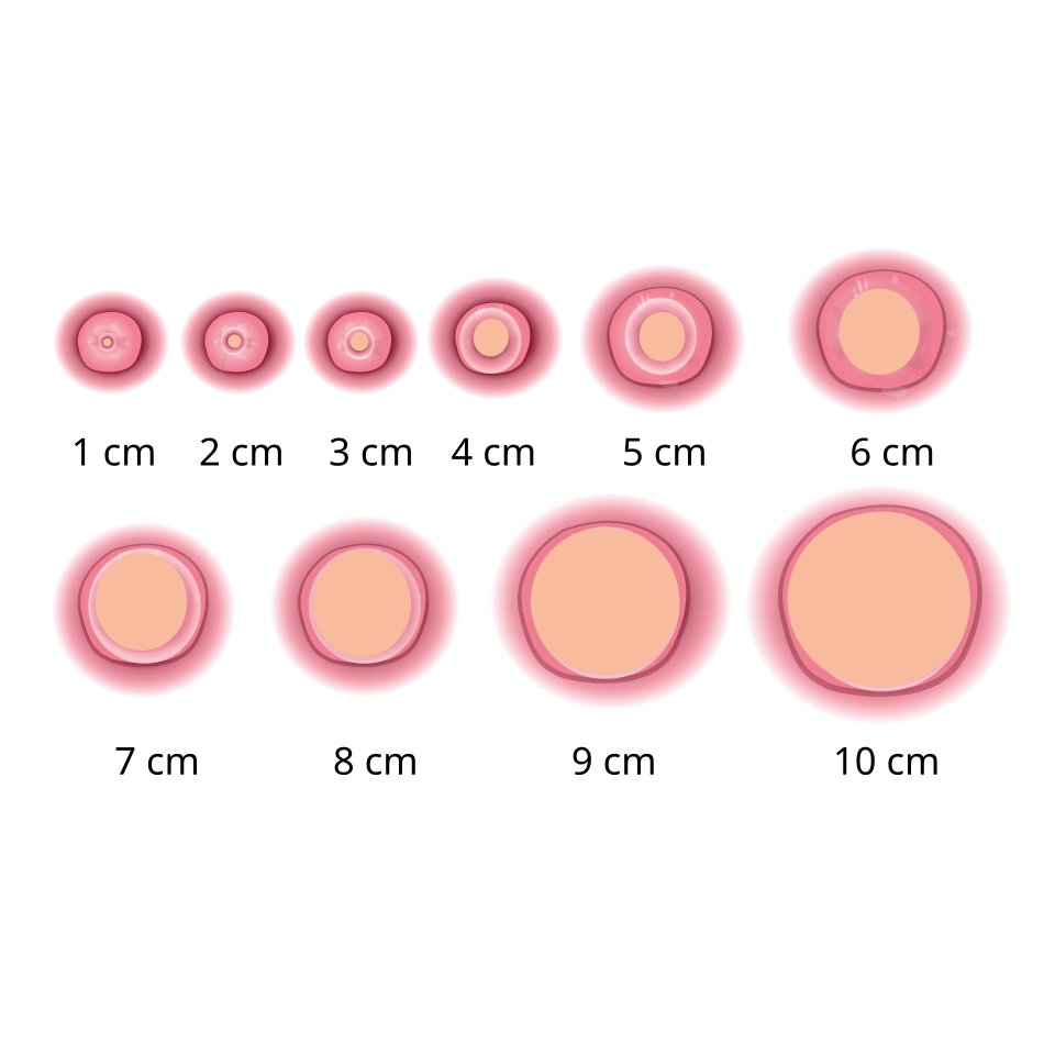 File:Servix dilation chart by hariadhi.svg