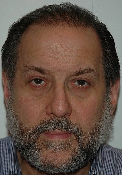 File:Man after receiving hair transplant.jpg