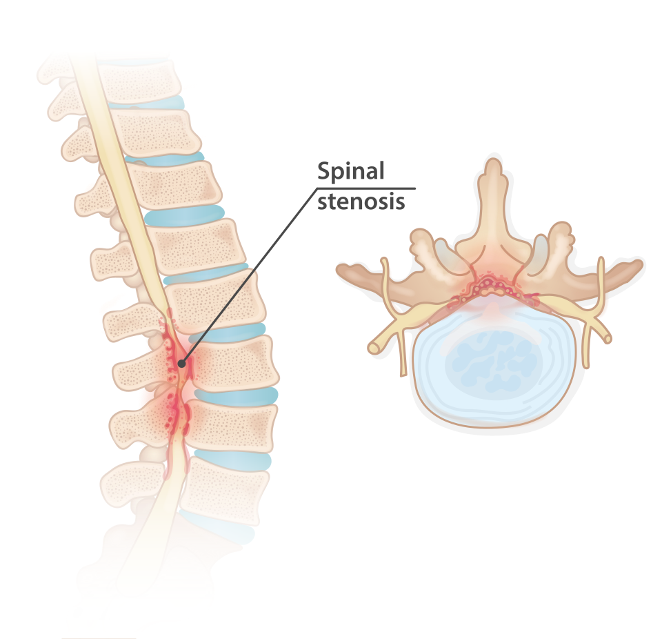 File:Spinal stenosis.svg