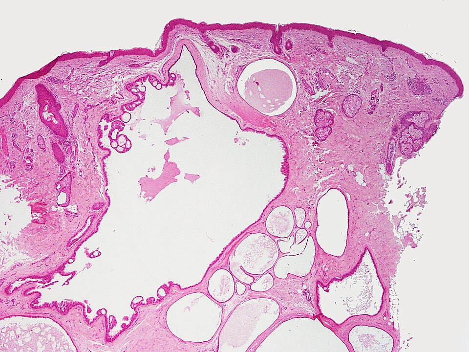 File:SkinTumors-P7110453.JPG
