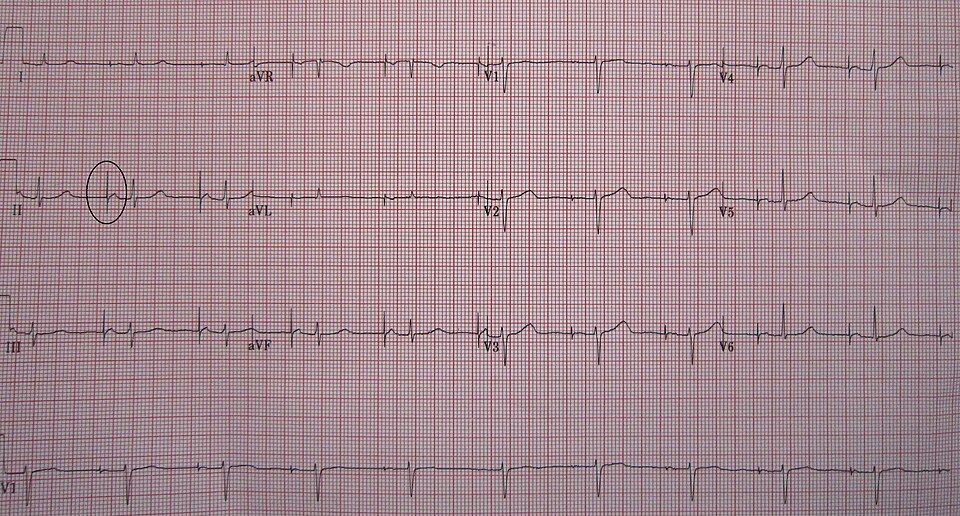 File:AtrialPacemakerECG.JPG