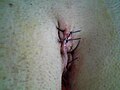 Pilonidal cyst two days after traditional closed surgery
