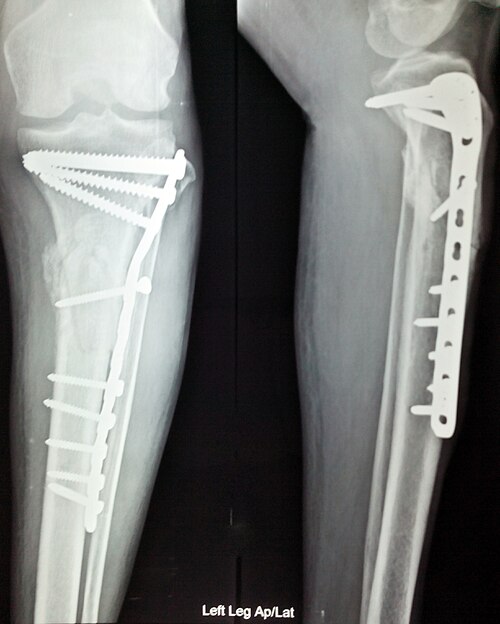 File:X ray internal fixation leg fracture.jpg