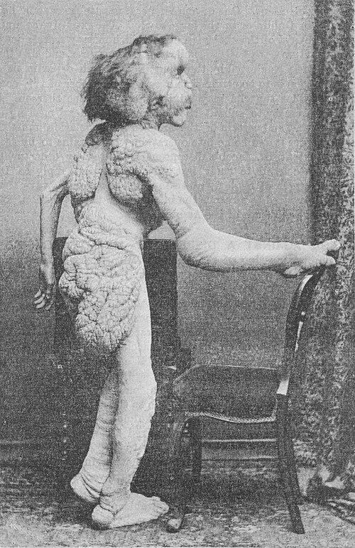 File:ElephantMan2.JPG