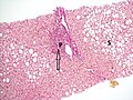 Histopathology of steatohepatitis with mild fibrosis in the form of fibrous expansion (Van Gieson's stain)