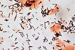 Gram stain of lactobacilli and squamous epithelial cells in vaginal swab