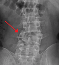 A burst fracture of L4 as seen on plane X ray