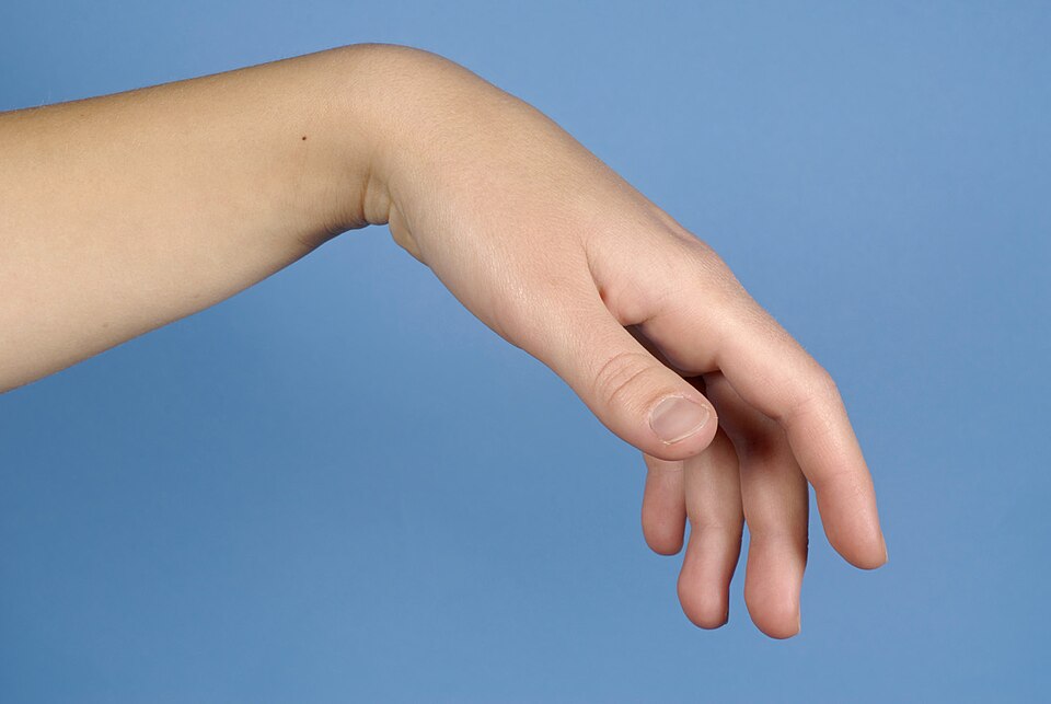 File:Tenodese hand.JPG