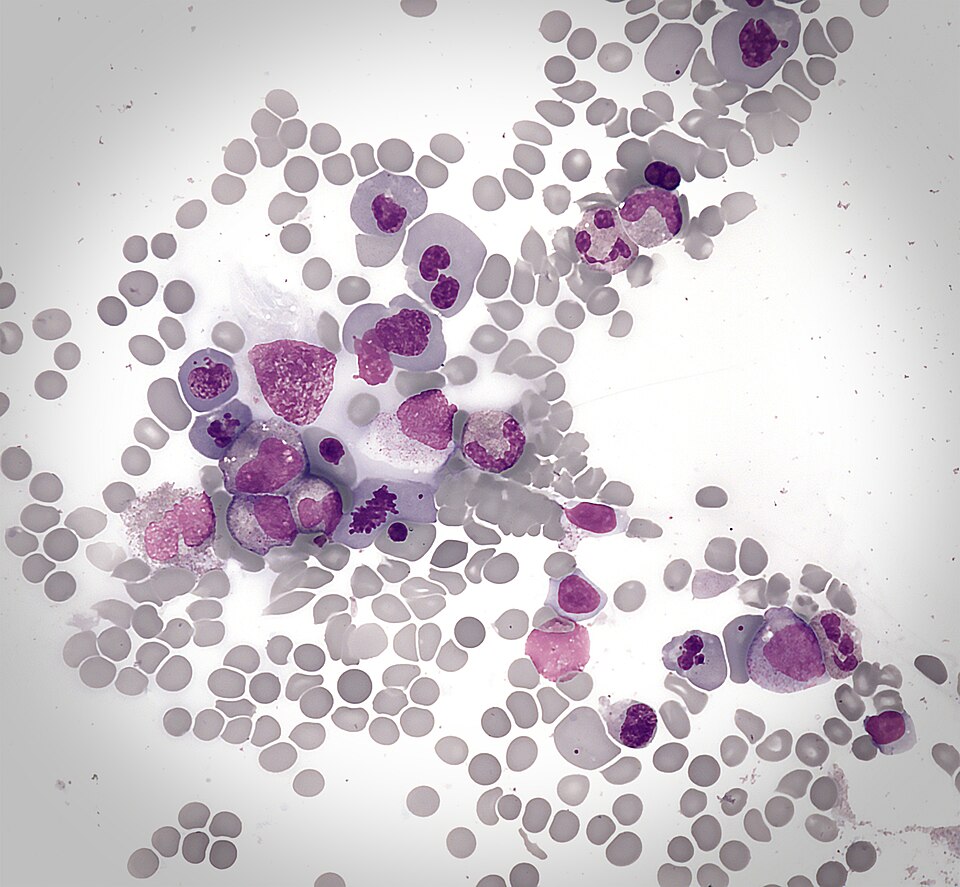 File:Megaloblasts in bone marrow.jpg