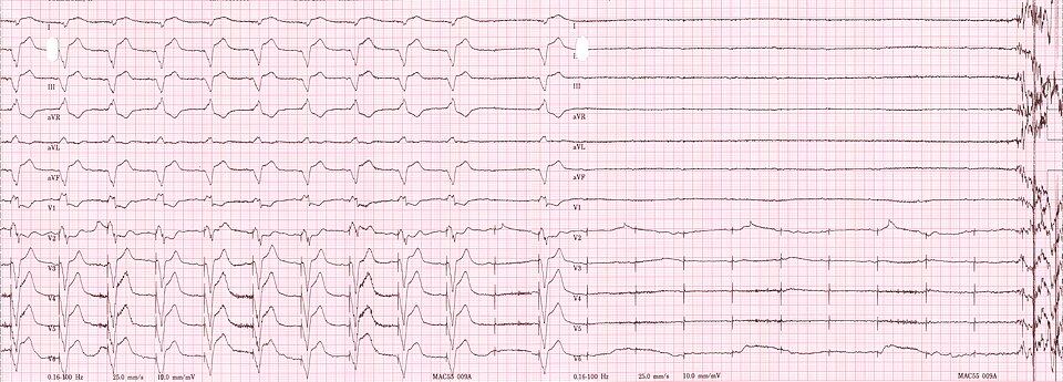 File:Pacemaker dependent asystole.jpg