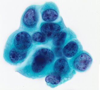 High-grade urothelial carcinoma (HGUC). By Mikael Häggström, Public Domain