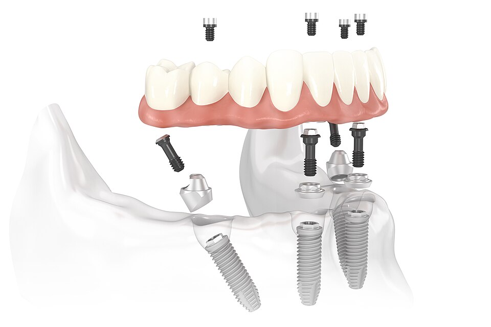 File:Nobel Biocare All-on-4 solution image 1.jpg
