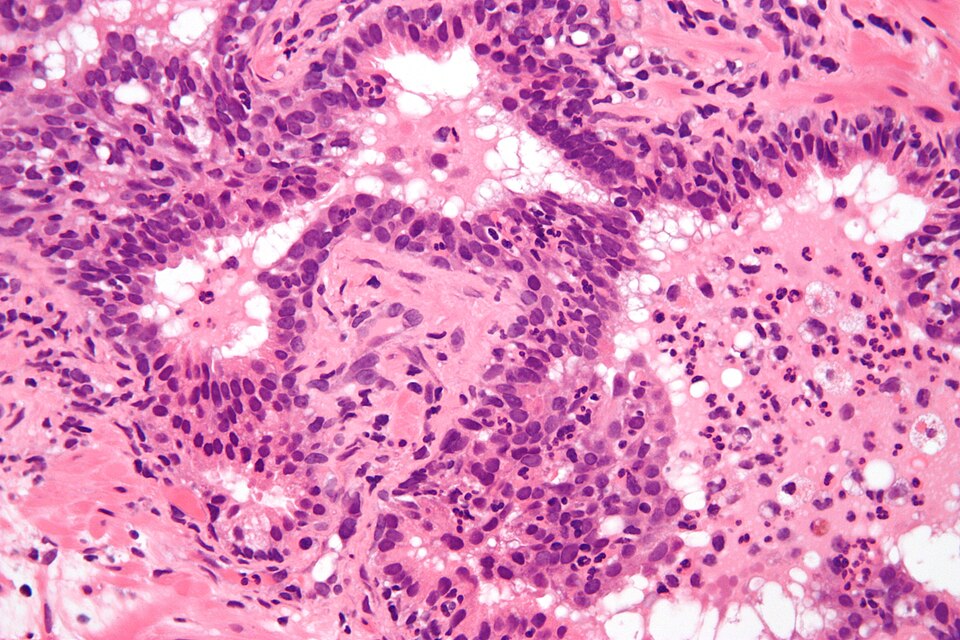 File:Acute inflammation of prostate.jpg