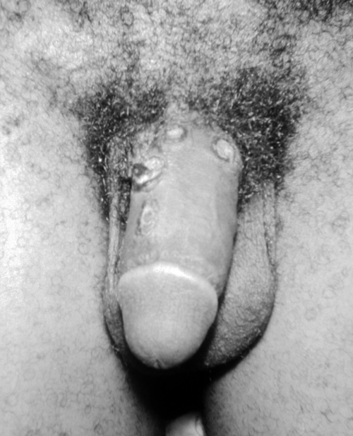 File:Penis syphilis.png