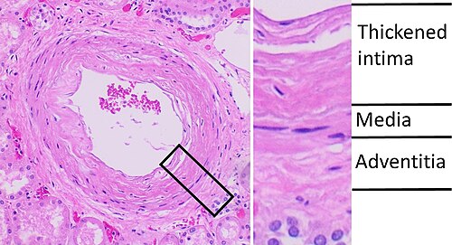 Histopathology of arcuate artery nephrosclerosis, seen as a thickened intima with an onion skin-like architecture. It is presumably a manifestation of hypertensive kidney disease.