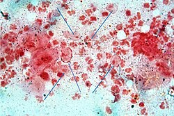 Trichomonas vaginalis (Gram stain)