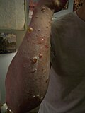 Blistering 48 hours after urushiol contact