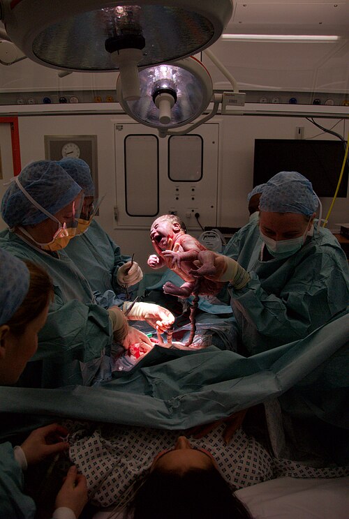 File:Cesarian the moment of birth.jpg