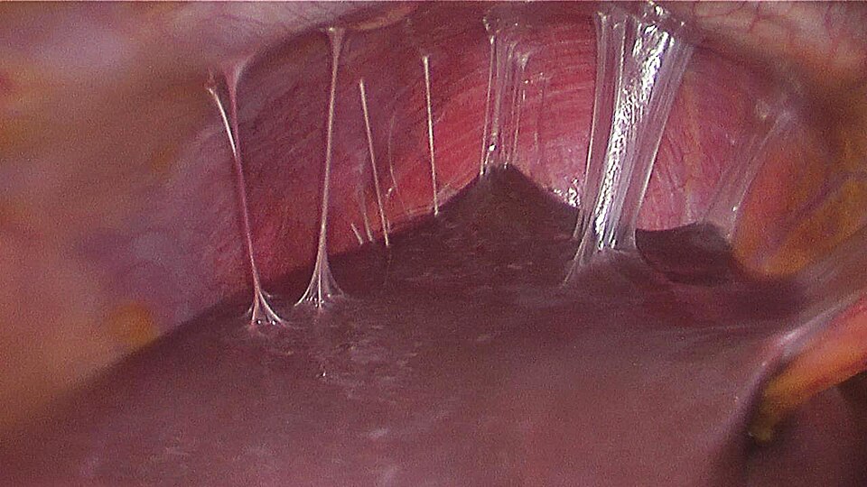 File:Perihepatic adhesions 2.jpg