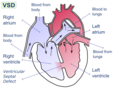 Ventricular septal defect