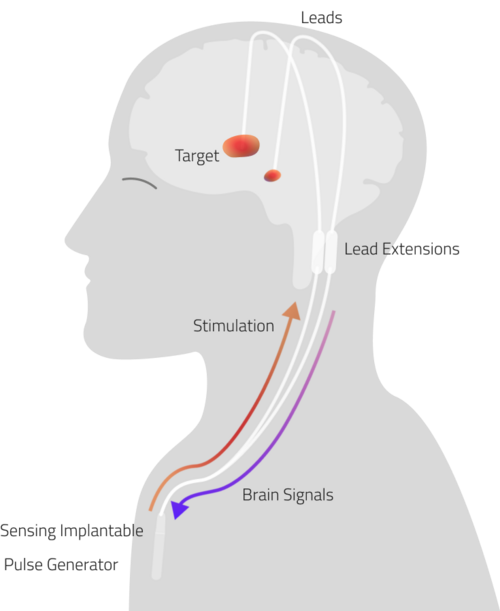 File:Adaptive Deep Brain Stimulation.png