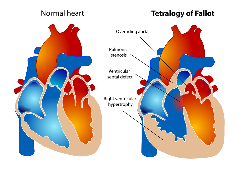 File:Tetralogy of Fallot.svg