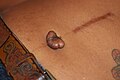 Well-healed midline scar of surgery, with keloid forming in the navel area following piercing