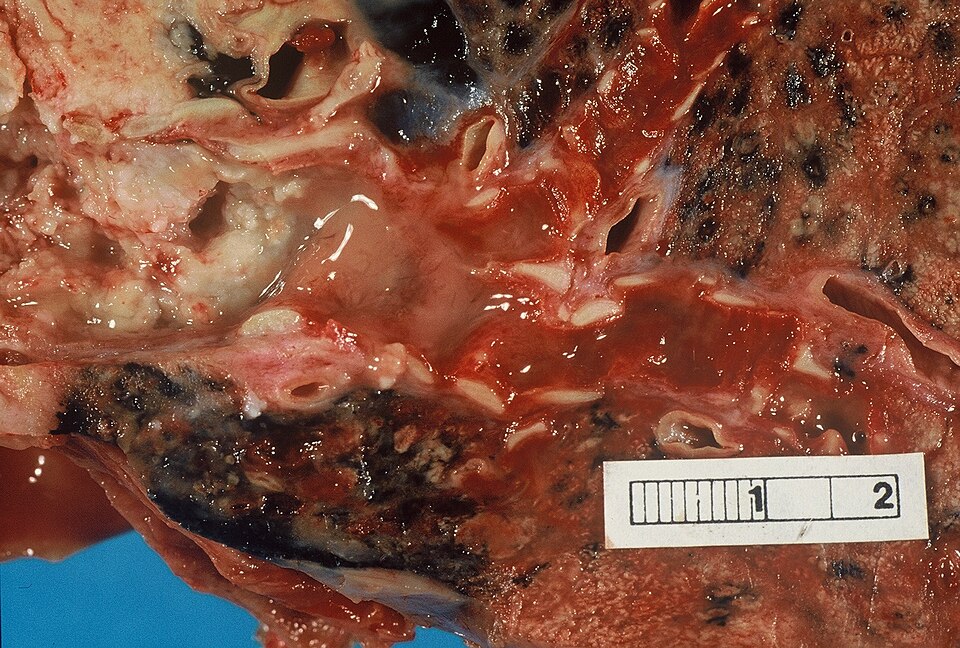 File:Ca bronchus.jpg