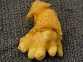 This ovarian teratoma has teeth