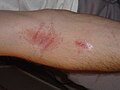 Poison ivy rash after 2 days